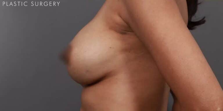After Image: Breast Augmentation Revision & Implant Exchange - left-side