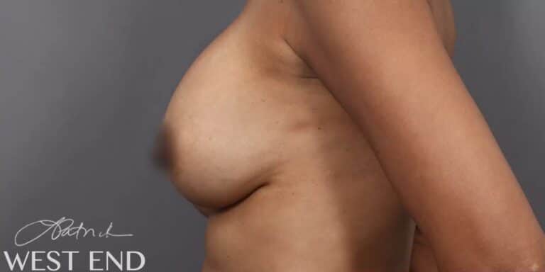 Before Image: Breast Augmentation Revision & Implant Exchange - left-side