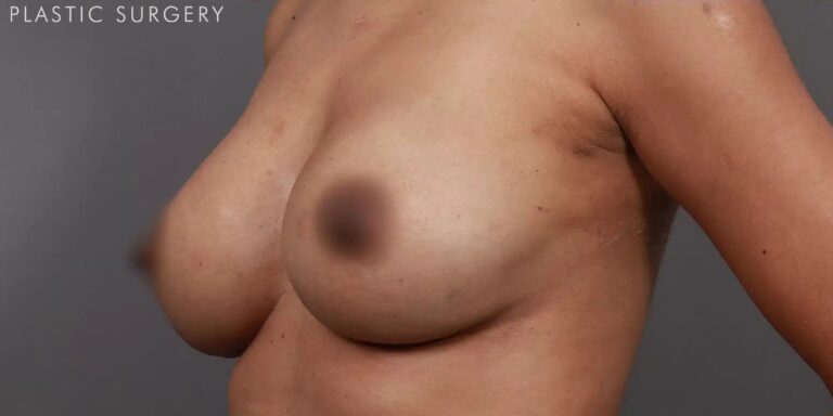 After Image: Breast Augmentation Revision & Implant Exchange - left-front-oblique