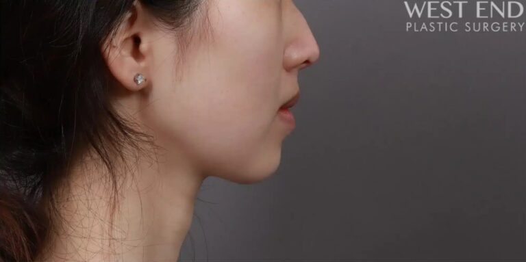After Image: Liposuction & Buccal Fat Pad Removal - right-side