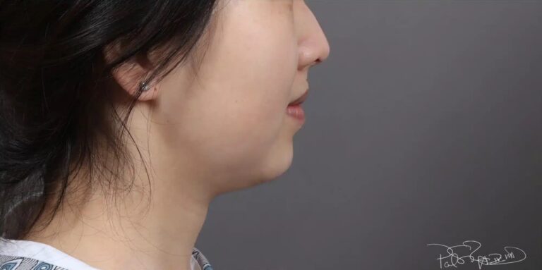 Before Image: Liposuction & Buccal Fat Pad Removal - right-side