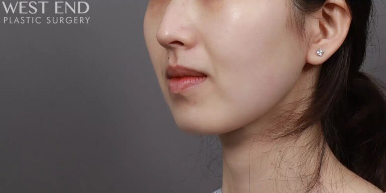 After Image: Liposuction & Buccal Fat Pad Removal - left-front-oblique