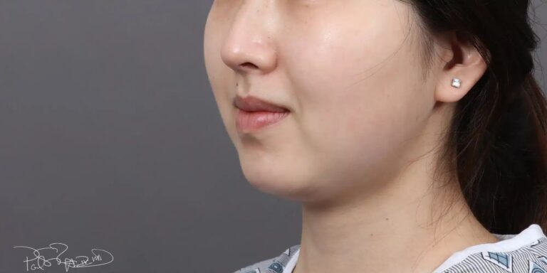 Before Image: Liposuction & Buccal Fat Pad Removal - left-front-oblique