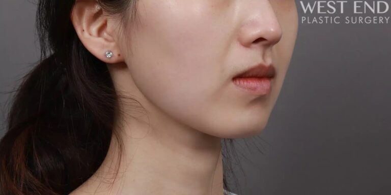 After Image: Liposuction & Buccal Fat Pad Removal - right-front-oblique