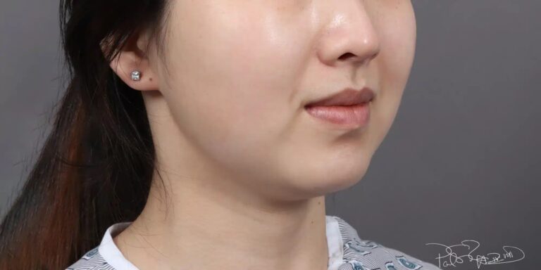 Before Image: Liposuction & Buccal Fat Pad Removal - right-front-oblique