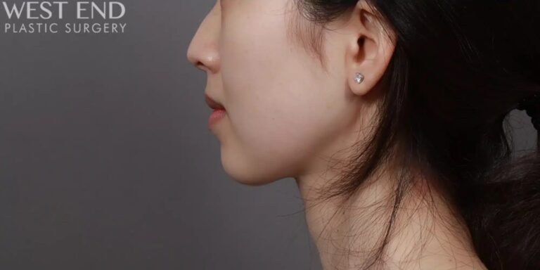 After Image: Liposuction & Buccal Fat Pad Removal - left-side