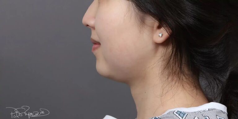 Before Image: Liposuction & Buccal Fat Pad Removal - left-side