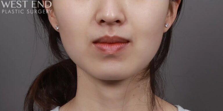 After Image: Liposuction & Buccal Fat Pad Removal - front