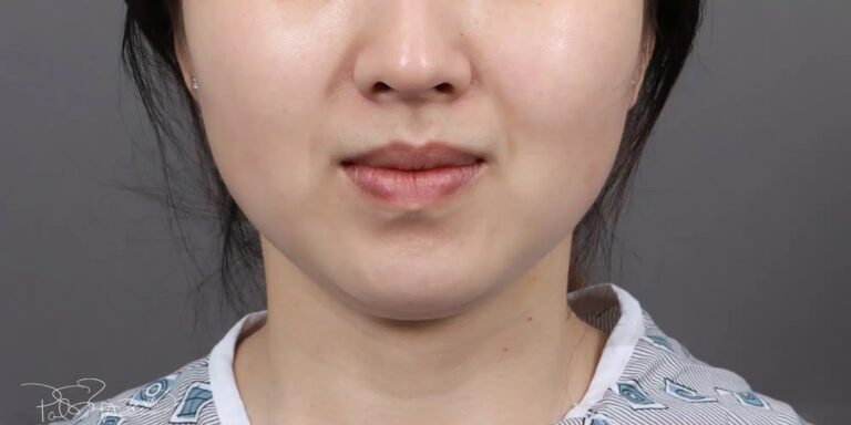 Before Image: Liposuction & Buccal Fat Pad Removal - front