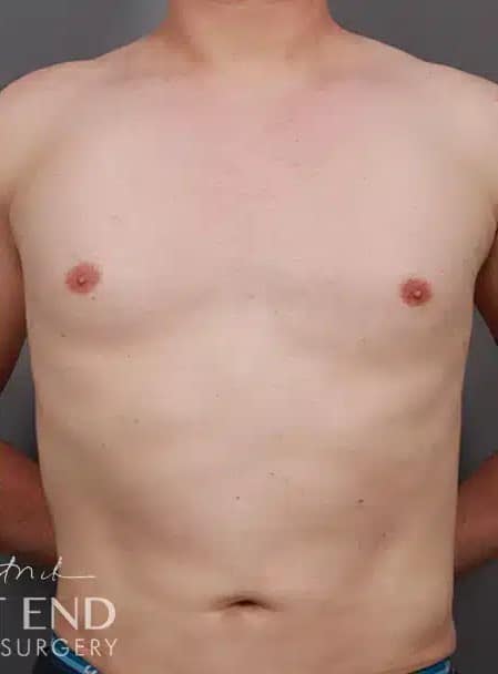 After Image: Gynecomastia (using Liposuction & Renuvion) - front