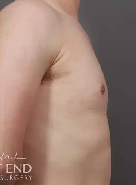 After Image: Gynecomastia (using Liposuction & Renuvion) - right-side
