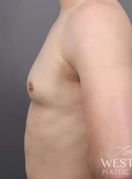 Before Image: Gynecomastia (using Liposuction & Renuvion) - left-side