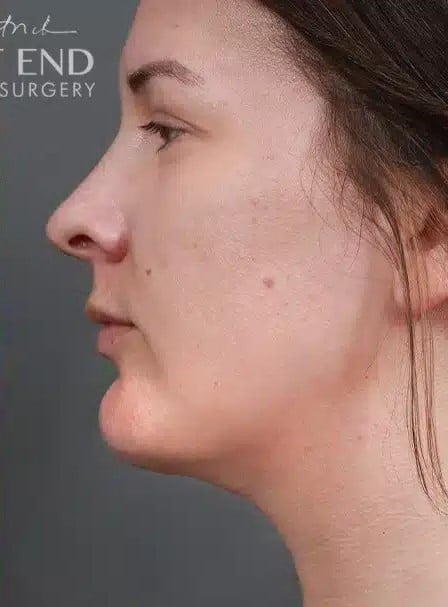 After Image: Submental & Neck Liposuction - left-side
