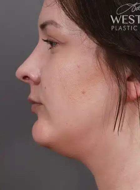 Before Image: Submental & Neck Liposuction - left-side