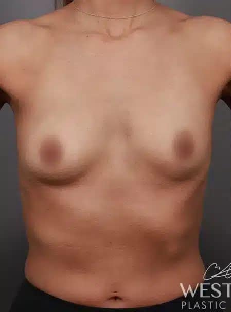 Before Image: Breast Augmentation - front