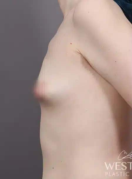 Before Image: Breast Augmentation - left-side