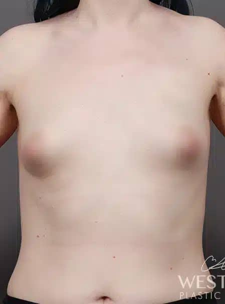 Before Image: Breast Augmentation - front