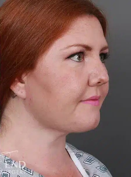 After Image: Submental Liposuction - right-front-oblique