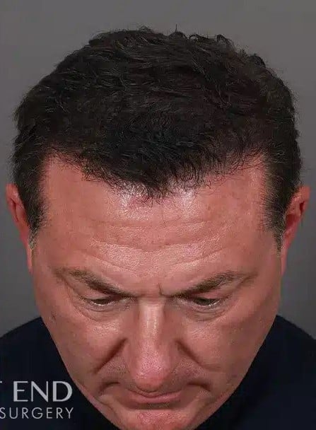 After Image: NeoGraft Hair Restoration - front