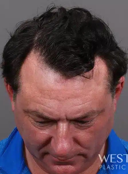 Before Image: NeoGraft Hair Restoration - front