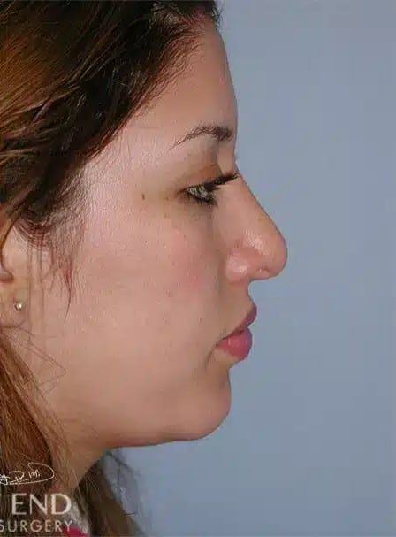 After Image: Rhinoplasty - right-side