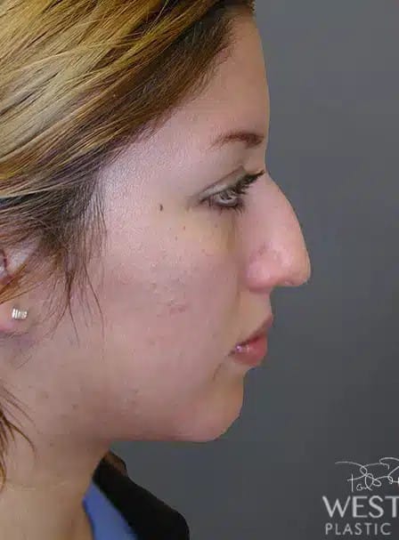 Before Image: Rhinoplasty - right-side
