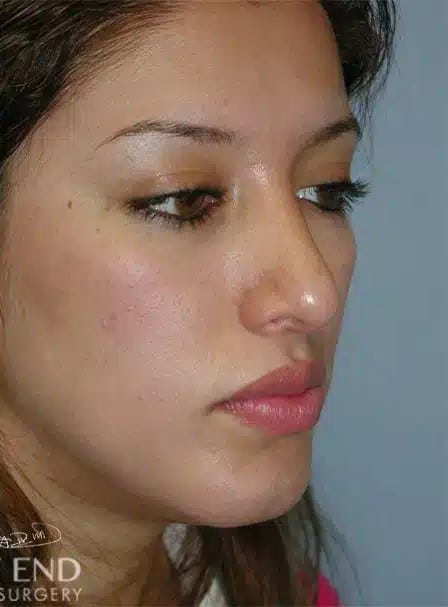 After Image: Rhinoplasty - right-front-oblique