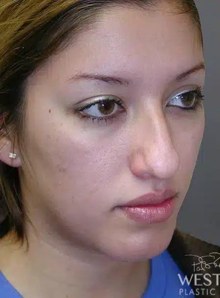 Before Image: Rhinoplasty - right-front-oblique