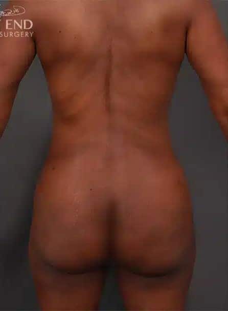 After Image: Liposuction, Renuvion Skin Tightening, and Brazilian Butt Lift - back