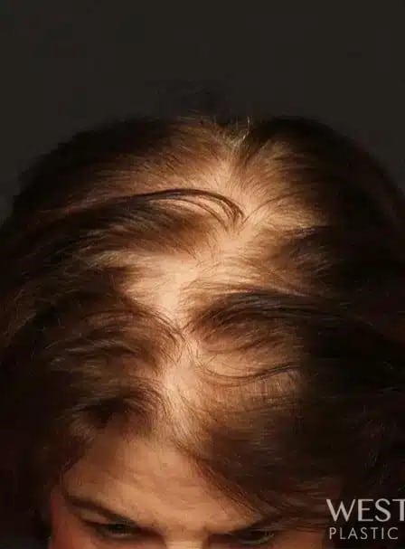 Before Image: NeoGraft Hair Restoration - front
