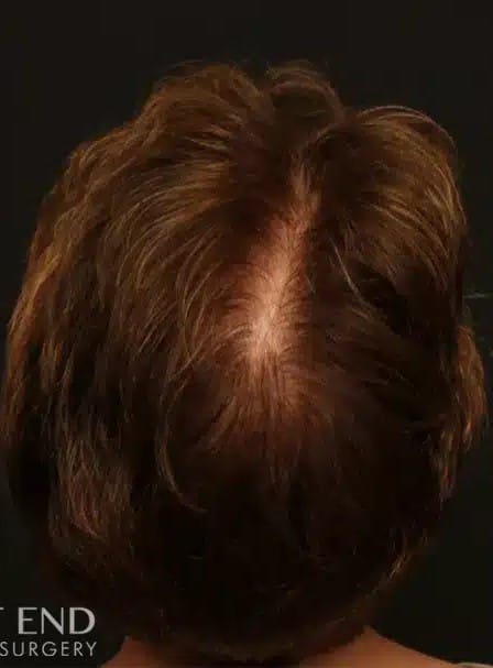After Image: NeoGraft Hair Restoration - back