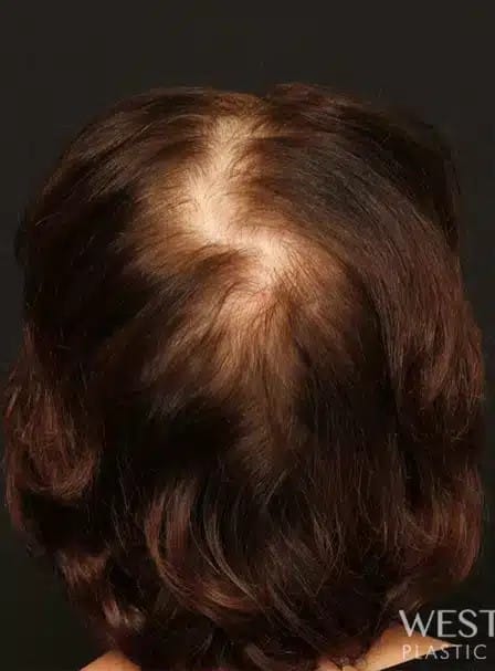 Before Image: NeoGraft Hair Restoration - back