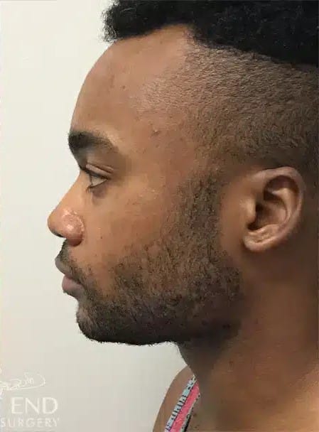 After Image: Liposuction & Buccal Fat Pad Removal - left-side