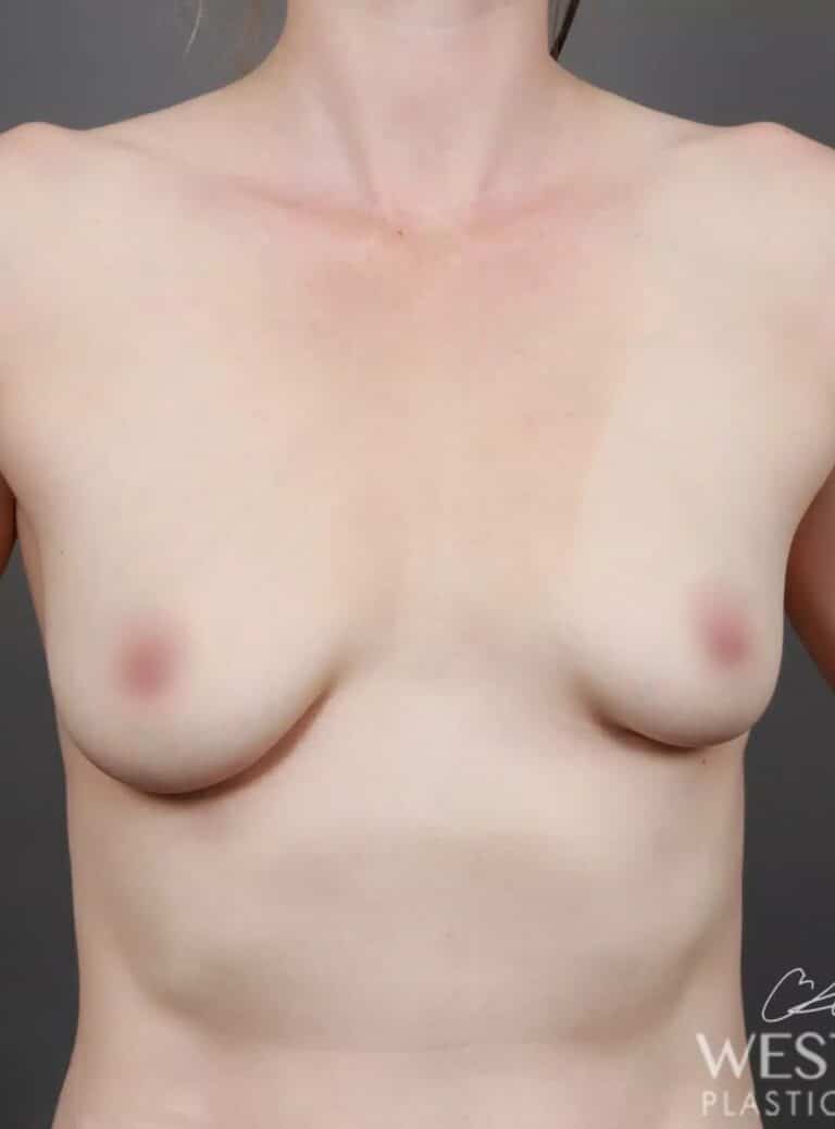 Before Image: Breast Augmentation - front