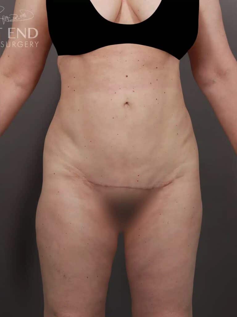 Plastic Surgery Case Study - Pubic Lift with Liposuction for Mons
