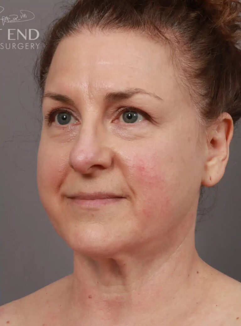 After Image: Liposuction & Renuvion Skin Tightening - left-front-oblique