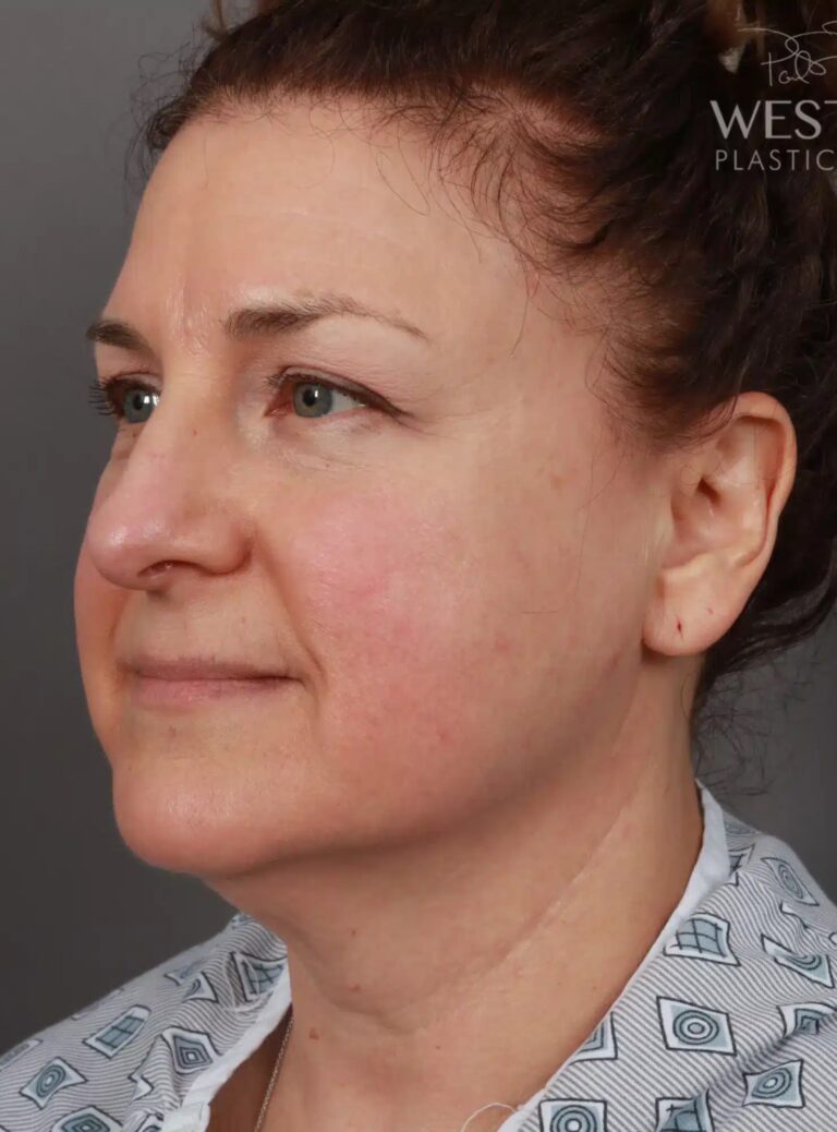 Before Image: Liposuction & Renuvion Skin Tightening - left-front-oblique