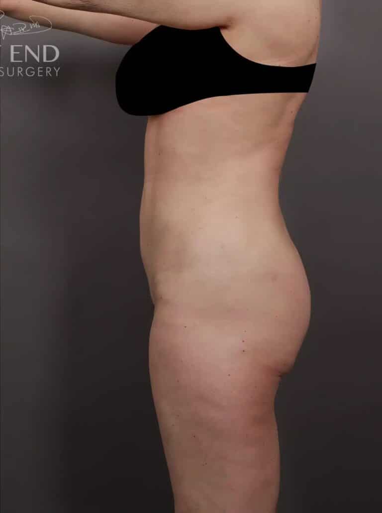 After Image: Mons Pubis Lift, Liposuction & Renuvion Skin Tightening - left-side