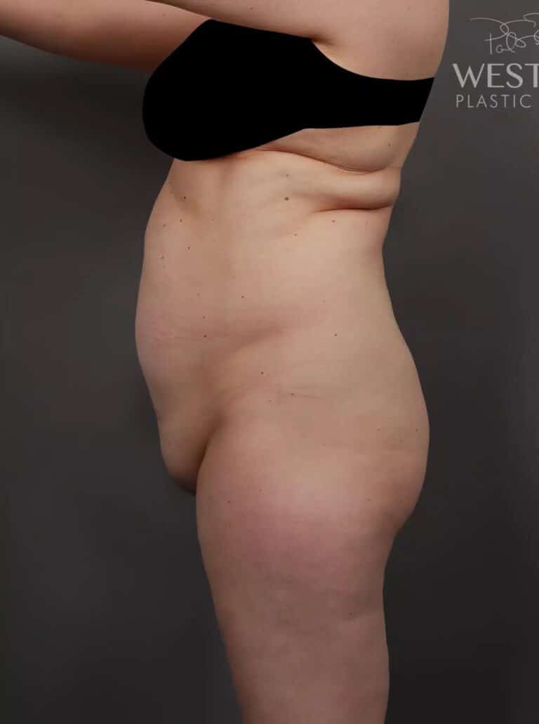 Before Image: Mons Pubis Lift, Liposuction & Renuvion Skin Tightening - left-side