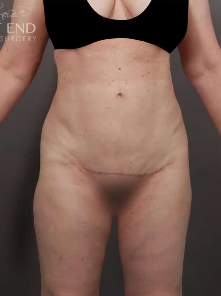 After Image: Mons Pubis Lift, Liposuction & Renuvion Skin Tightening - front