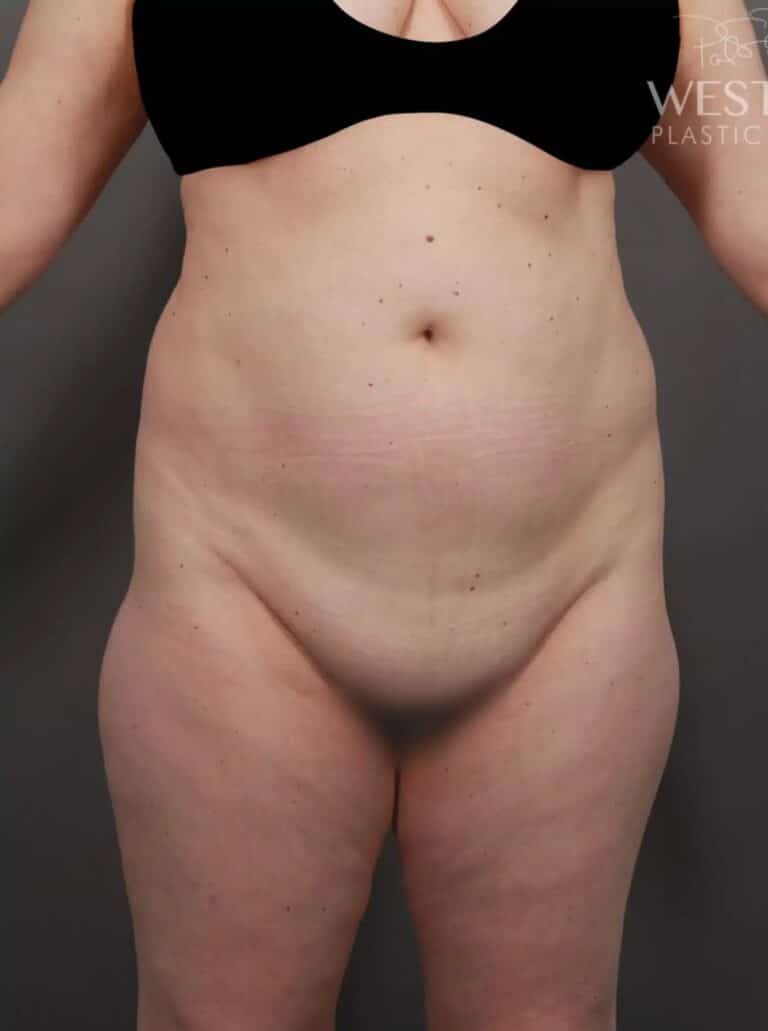 Before Image: Mons Pubis Lift, Liposuction & Renuvion Skin Tightening - front