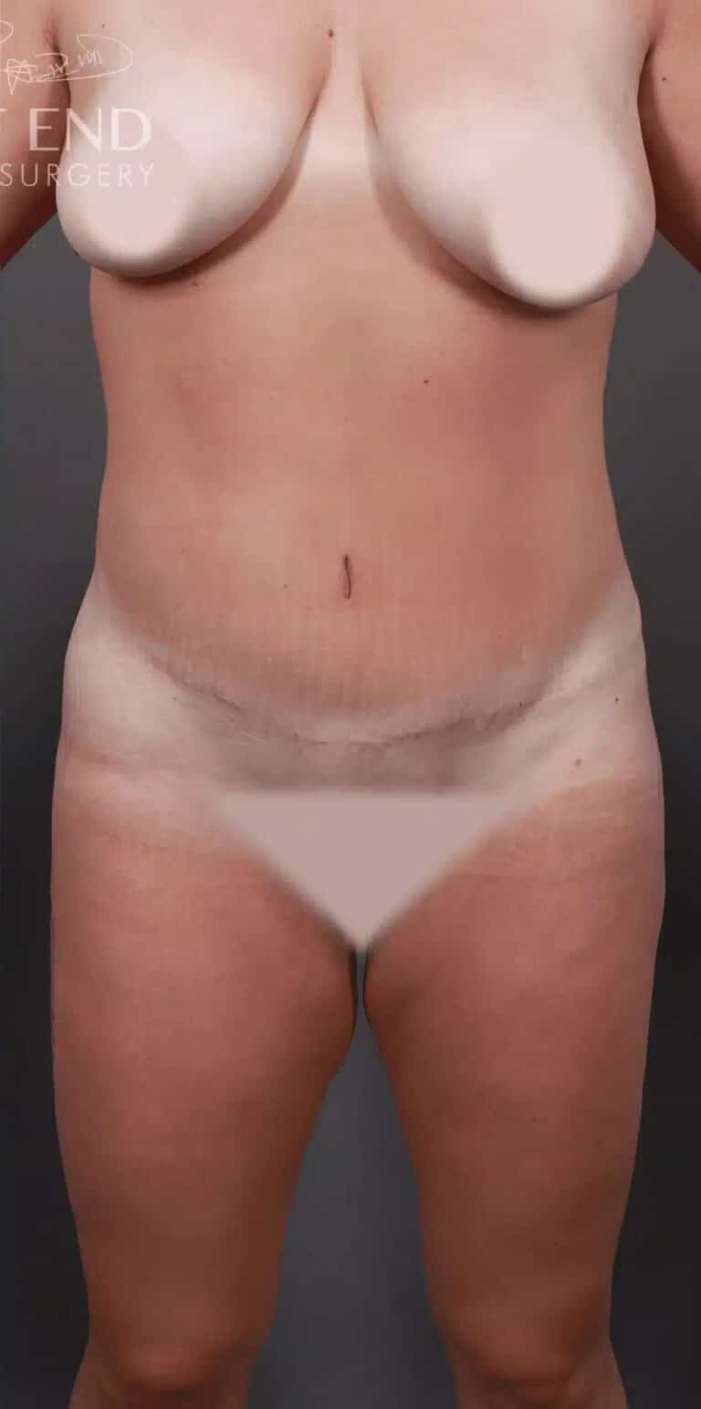 After Image: Liposuction & Brazilian Butt Lift - front