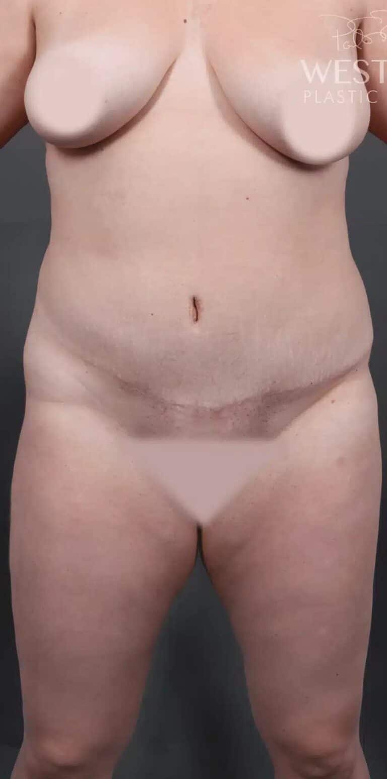 Before Image: Liposuction & Brazilian Butt Lift - front