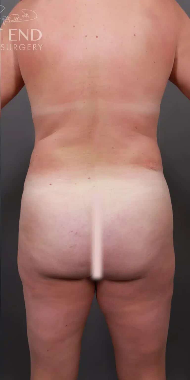 After Image: Liposuction & Brazilian Butt Lift - back