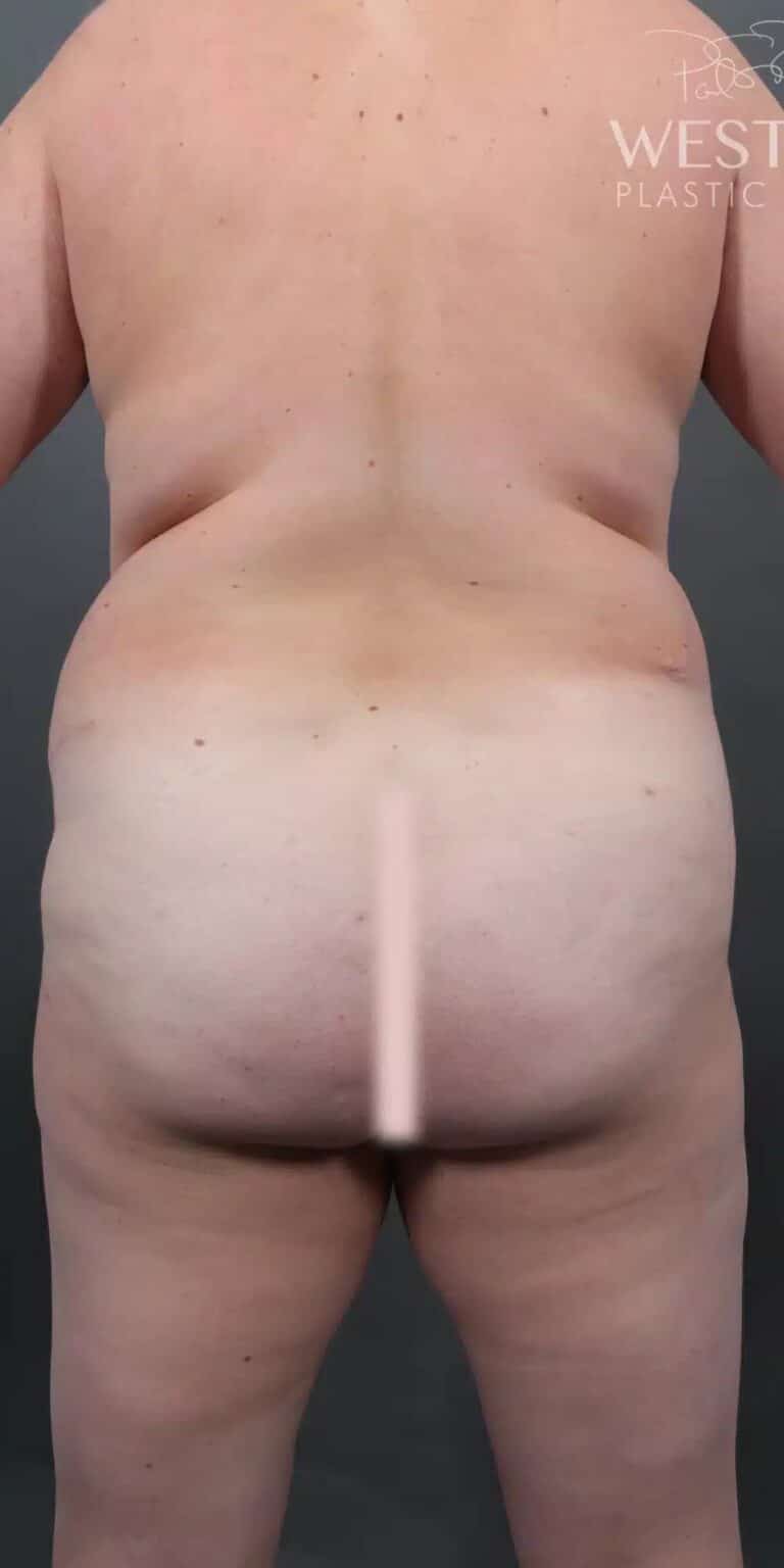 Before Image: Liposuction & Brazilian Butt Lift - back