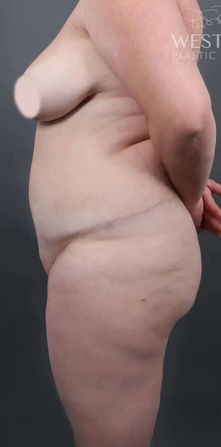 Before Image: Liposuction & Brazilian Butt Lift - left-side