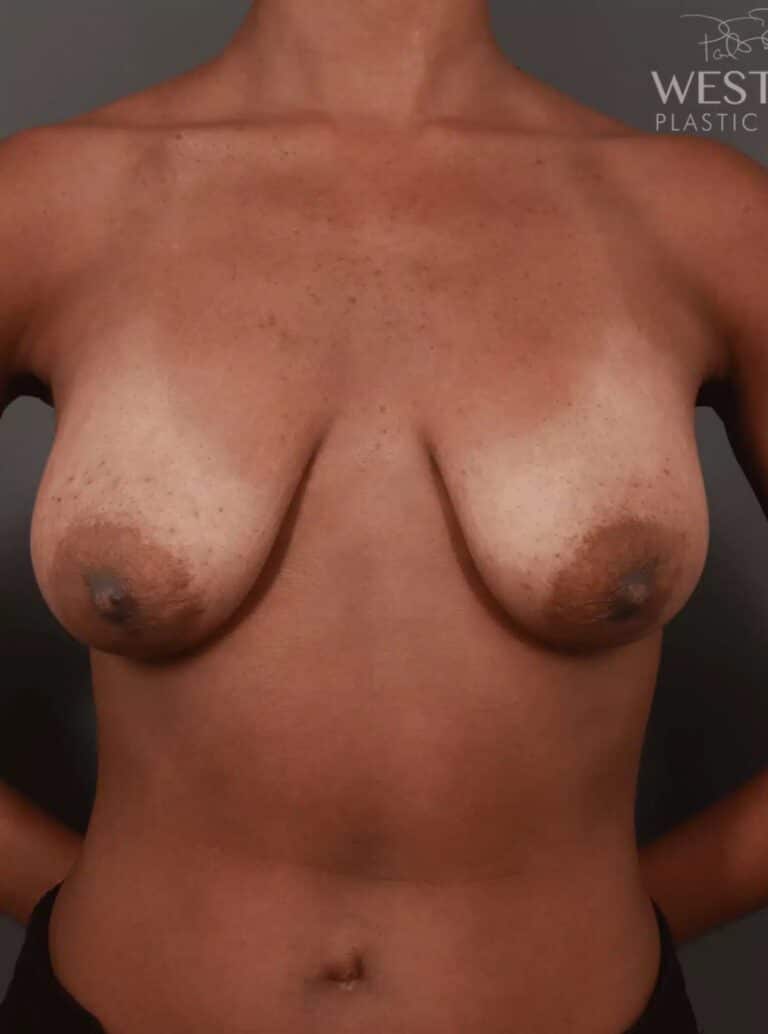Before Image: Breast Lift with Implants & Umbilical Hernia Repair - front