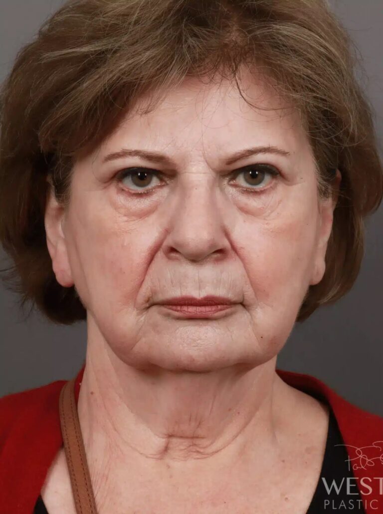 Before Image: Deep Plane Facelift & Neck Lift, Brow Lift, Eyelid Lift, Fat Grafting, and CO2 Resurfacing (2.5 Months Post-Op) - front