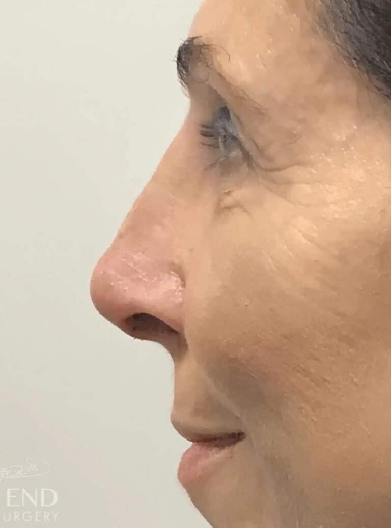 After Image: Rhinoplasty (9 Days Post-Op) - left-side