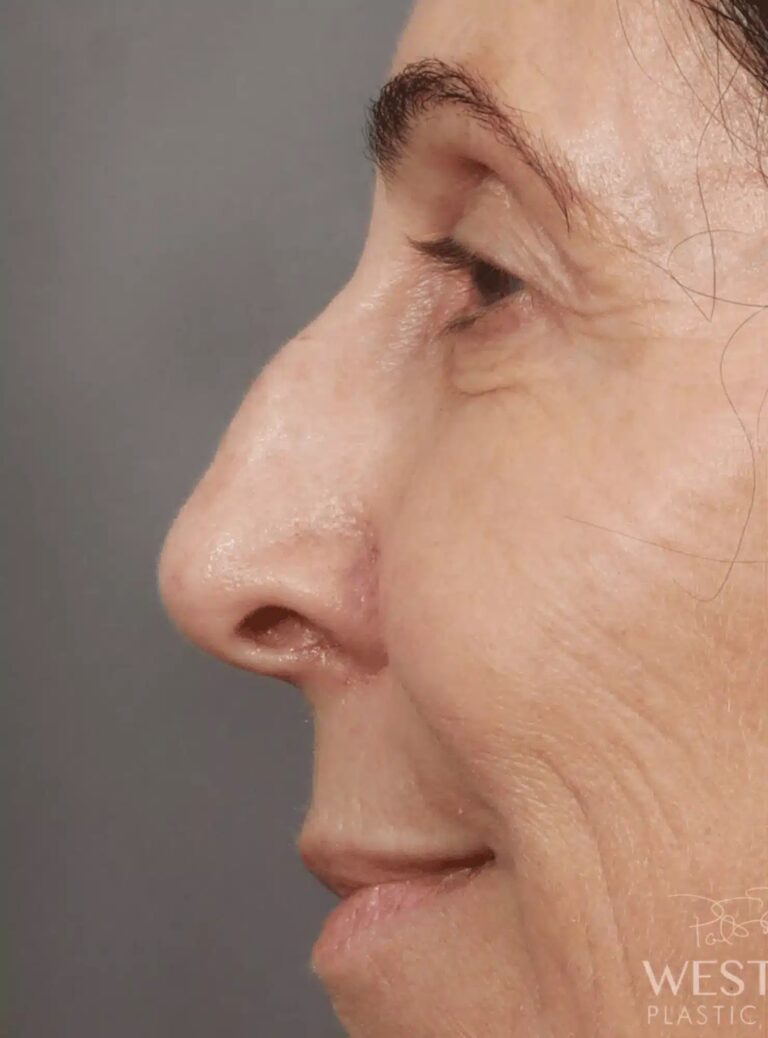 Before Image: Rhinoplasty (9 Days Post-Op) - left-side